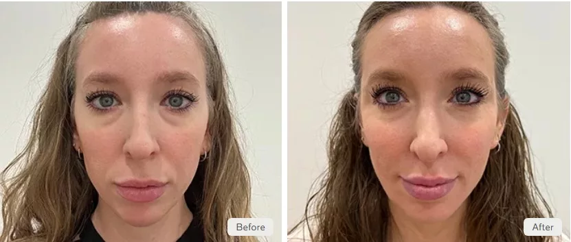 Before and after cheek filler to add volume to the mid-face, reducing the appearance on under-eye hollows. Performed at The Skin Center in Pittsburgh, PA.