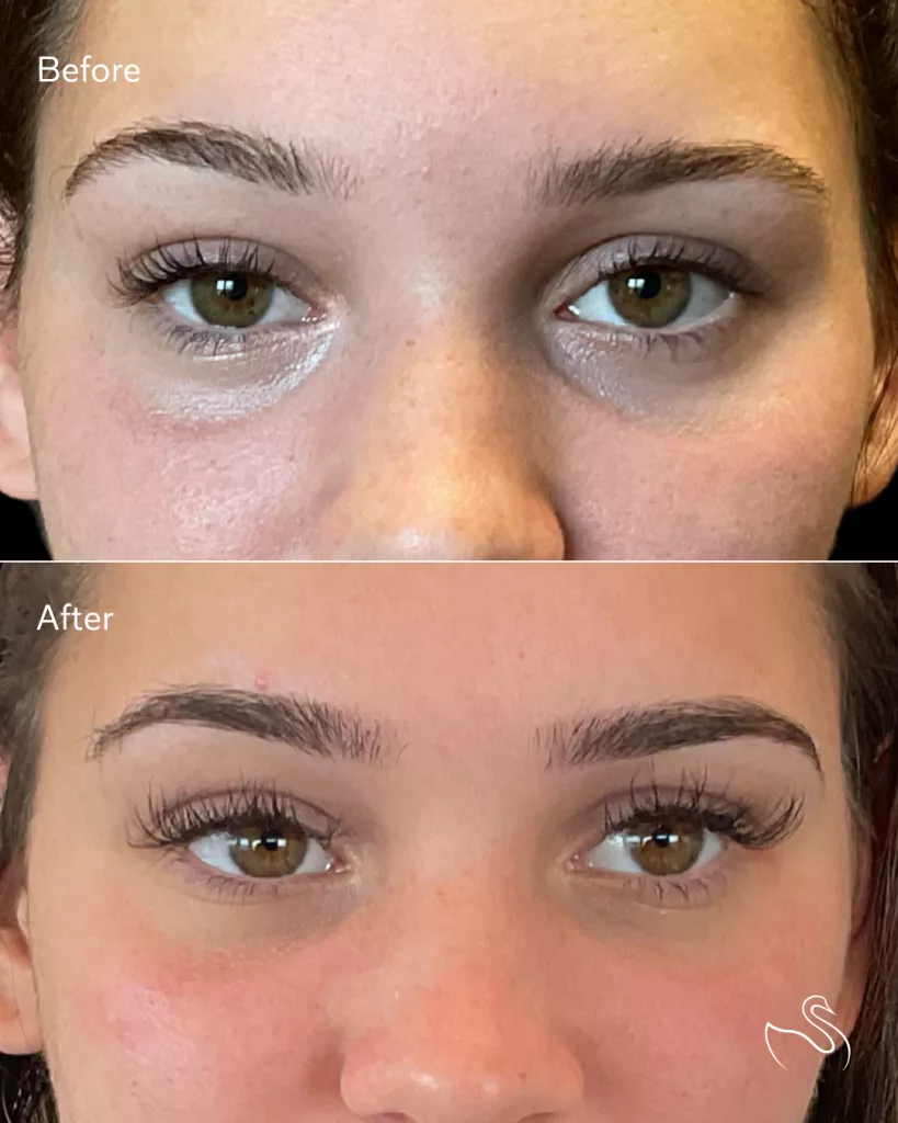 Before and After PRF EZGEL treatment for adding volume to under-eye hollows and fade dark under-eye circles. Performed at The Skin Center in Pittsburgh, PA.