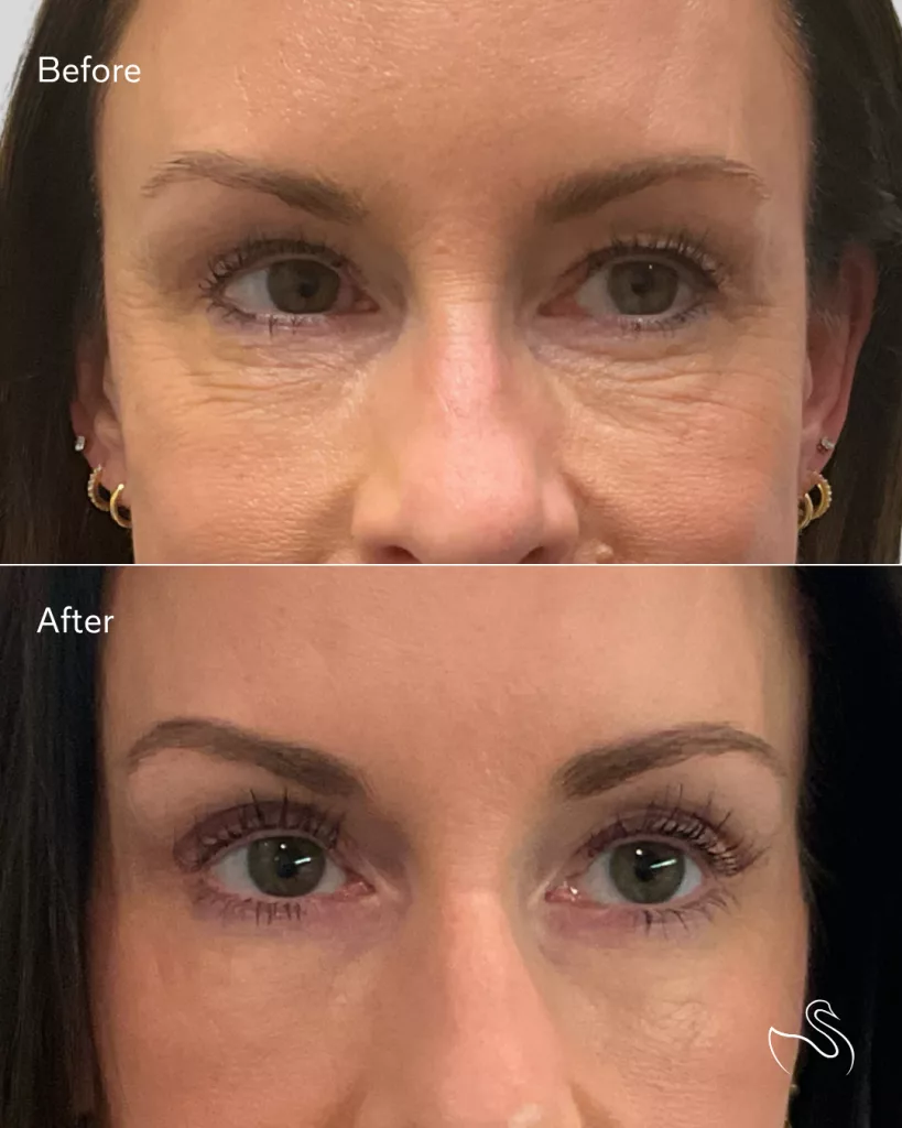 Before and after PRF injection to treat crepey under-eye skin and under-eye circles. Performed at The Skin Center in Pittsburgh, PA.