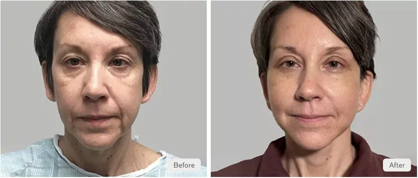 Female patient before and after blepharoplasty photos to treat hooded eyelids and under-eye bags.