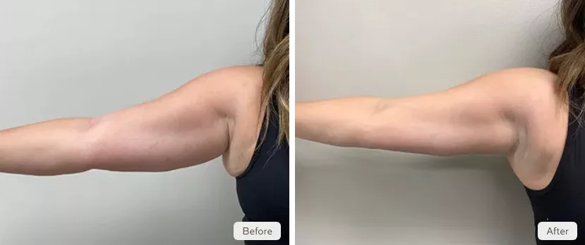 Before and After two Coolsculpting Elite treatments for underarm fat. Performed at The Skin Center in Pittsburgh, PA.