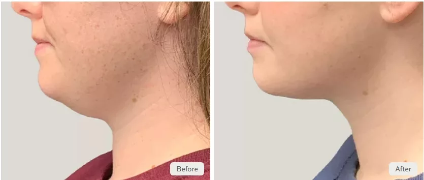 Before and After two CoolSculpting Elite treatments for double chin fat reduction. Performed at The Skin Center in Pittsburgh, PA.