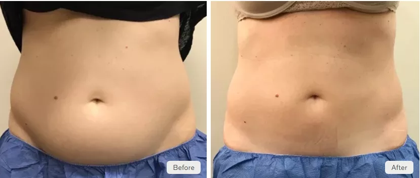 Before and After 2 CoolSculpting Elite treatments for permanent fat reduction in abdomen. Performed at The Skin Center in Pittsburgh, PA.