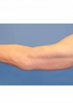 Brachioplasty Arm Lift