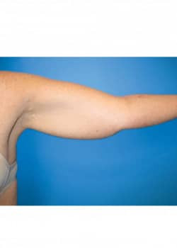 Brachioplasty Arm Lift