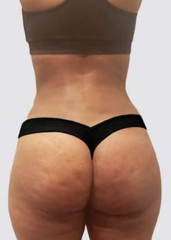 Brazillian Butt Lift And Liposuction