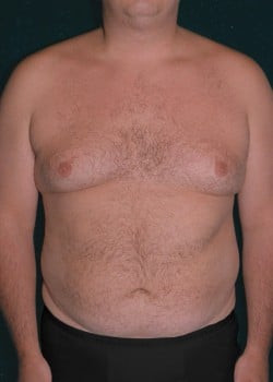 Liposuction Men