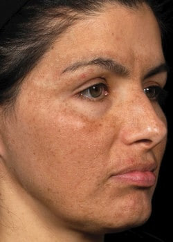 Fraxel Laser Skin Resurfacing