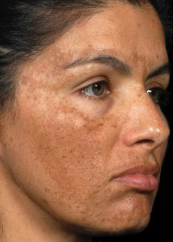 Fraxel Laser Skin Resurfacing