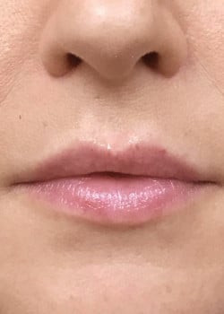 Lip Augmentation Case ID 9100