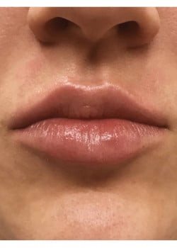 Lip Augmentation Case ID 9535