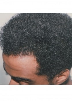 Hair Restoration Men
