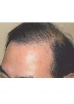 Hair Restoration Men