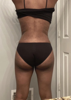 Brazillian Butt Lift And Liposuction