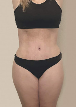 Tummy Tuck And Abdominal Etching And Brazillian Butt Lift And Liposuction