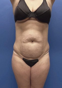 Tummy Tuck And Abdominal Etching And Brazillian Butt Lift And Liposuction