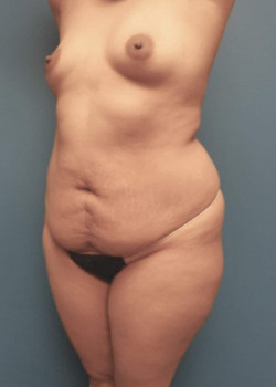 Liposuction And Brazilian Butt Lift And Breast Augmentation
