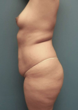 Liposuction And Brazilian Butt Lift And Breast Augmentation