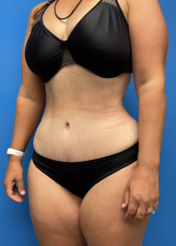 Liposuction And Tummy Tuck And Abdominal Etching
