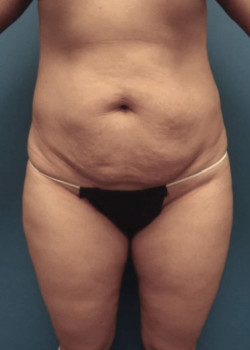 Liposuction And Tummy Tuck And Abdominal Etching And Brazilian Butt Lift