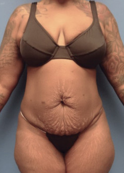Liposuction And Tummy Tuck And Brazilian Butt Lift