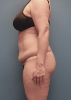 Liposuction And Tummy Tuck And Brazilian Butt Lift