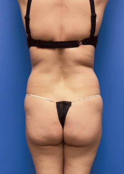 Liposuction And Abdominal Etching And Brazilian Butt Lift