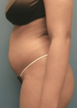 Liposuction And Brazilian Butt Lift