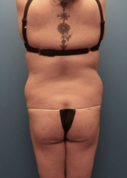 Liposuction And Brazilian Butt Lift