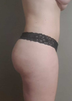 Liposuction and Brazilian Butt Lift