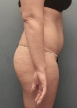 Liposuction and Brazilian Butt Lift