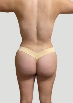 Liposuction And Breast Lift And Brazilian Butt Lift