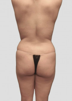 Liposuction And Breast Lift And Brazilian Butt Lift